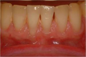 Gum Grafting, Before and After, Periodontist, Receding Gums