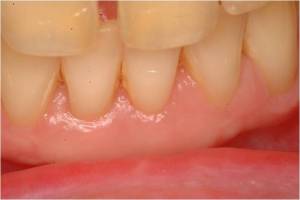 Gum Grafting, Before and After, Periodontist, Receding Gums, West Lebanon