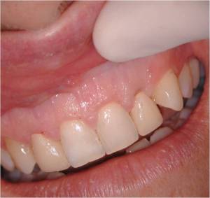 Gum Grafting, Before and After, Periodontist, Gummy Smile, West Lebanon