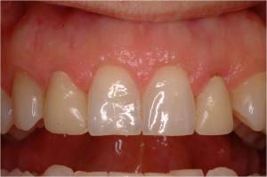 Gum Grafting, Before and After, Periodontist, Smile, West Lebanon