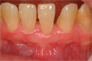 Gum Grafting, Before and After, Periodontist, Receding Gums