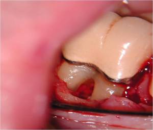 Periodontist, West Labanon, Periodontal Micosurgery, Magnify 10x
