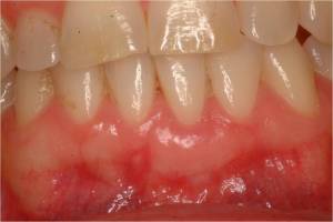 Gum Grafting, Before and After, Periodontist, Receding Gums