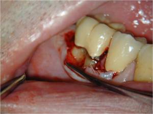 Periodontist, West Labanon, Periodontal Micosurgery, Magnify 4x