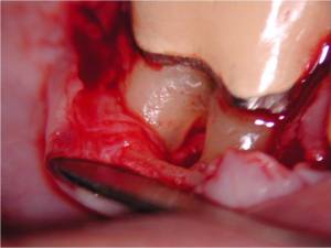 Periodontist, West Labanon, Periodontal Micosurgery, Magnify 16x