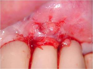 Dihiscence over an implant grafted