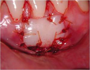Epithilialized Palatal Grafts, Periodontist