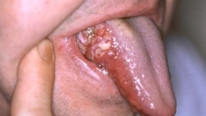 Oral Cancer example