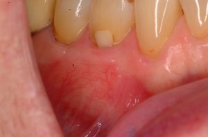 Gum Grafting, Before and After, Periodontist, Receding Gums