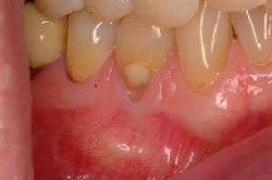 Gum Grafting, Before and After, Periodontist, Receding Gums