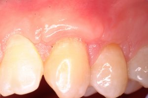 Gum Grafting, Before and After, Periodontist, Receding Gums