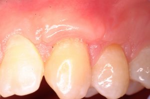 Gum Grafting, Before and After, Periodontist, Receding Gums