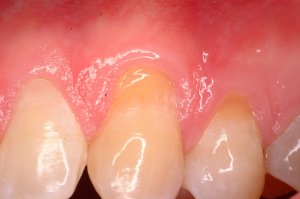 Gum Grafting, Before and After, Periodontist, Receding Gums, West Lebanon