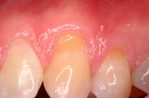 Gum Grafting, Before and After, Periodontist, Receding Gums, West Lebanon