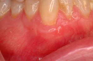 Gum Grafting, Before and After, Periodontist, Receding Gums, West Lebanon