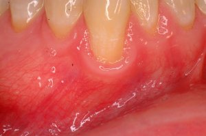 Gum Grafting, Before and After, Periodontist, Receding Gums