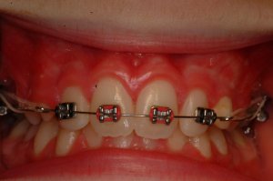 Laser Gum Surgery, Before and After, Periodontist, Gingiva, West Lebanon