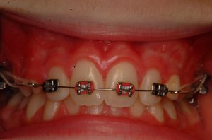 Laser Gum Surgery, Before and After, Periodontist, Gingiva, West Lebanon