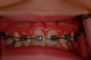 Laser Gum Surgery, Before and After, Periodontist, Gingiva