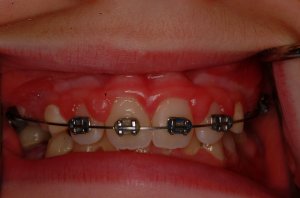 Laser Gum Surgery, Before and After, Periodontist, Gingiva