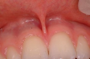 Frenectomy example