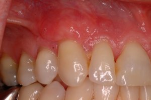 Gum Grafting, Before and After, Periodontist, Receding Gums