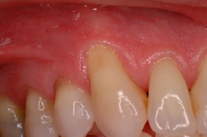 Gum Grafting, Before and After, Periodontist, Receding Gums