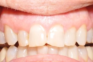 Laser Gum Surgery, Before and After, Periodontist, Gingiva
