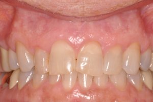 Laser Gum Surgery, Before and After, Periodontist, Gingiva