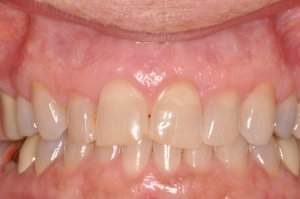 Laser Gum Surgery, Before and After, Periodontist, Gingiva