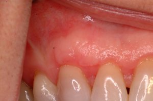 Gum Grafting, Before and After, Periodontist, Receding Gums