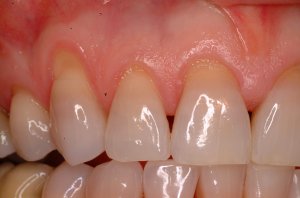 Gum Grafting, Before and After, Periodontist, Receding Gums, West Lebanon