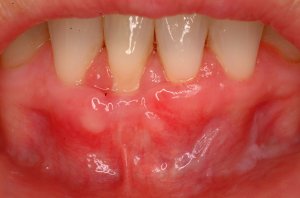 Gum Grafting, Before and After, Periodontist, Receding Gums
