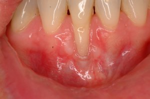 Gum Grafting, Before and After, Periodontist, Receding Gums, West Lebanon