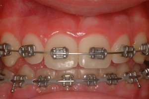 Laser Gum Surgery, Before and After, Periodontist, Gingiva, West Lebanon