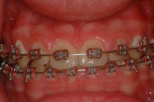 Laser Gum Surgery, Before and After, Periodontist, Gingiva