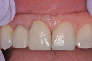 Laser Gum Surgery, Before and After, Periodontist, Gingiva