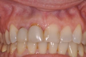 Laser Gum Surgery, Before and After, Periodontist, Gingiva